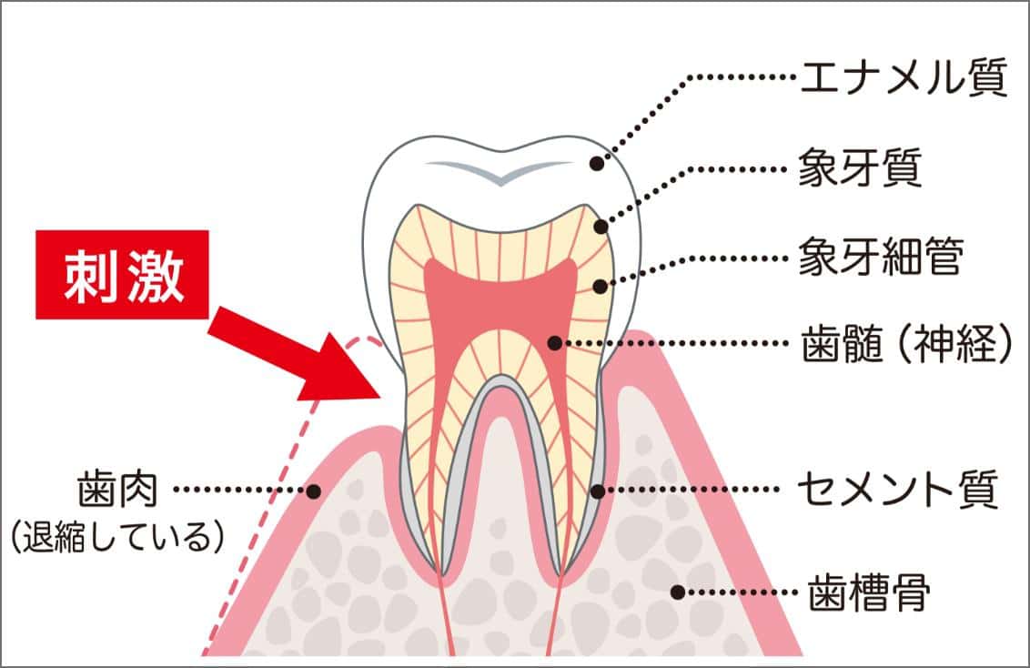 歯肉退縮 断面図