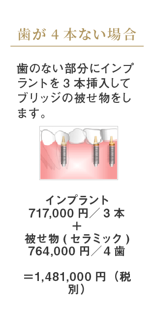 歯が4本ない場合