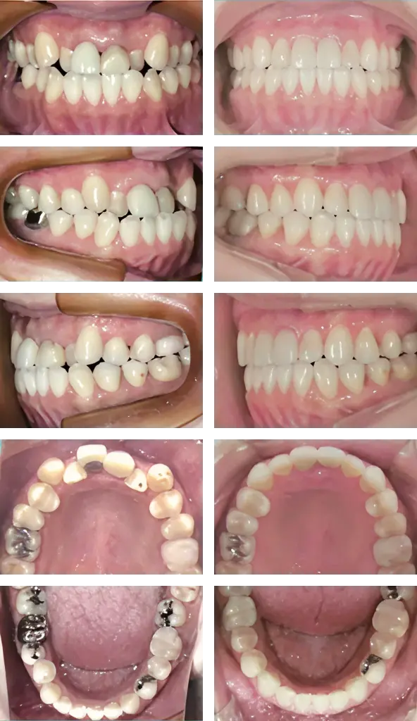 ガタガタ・反対咬合・被せ物の不適合