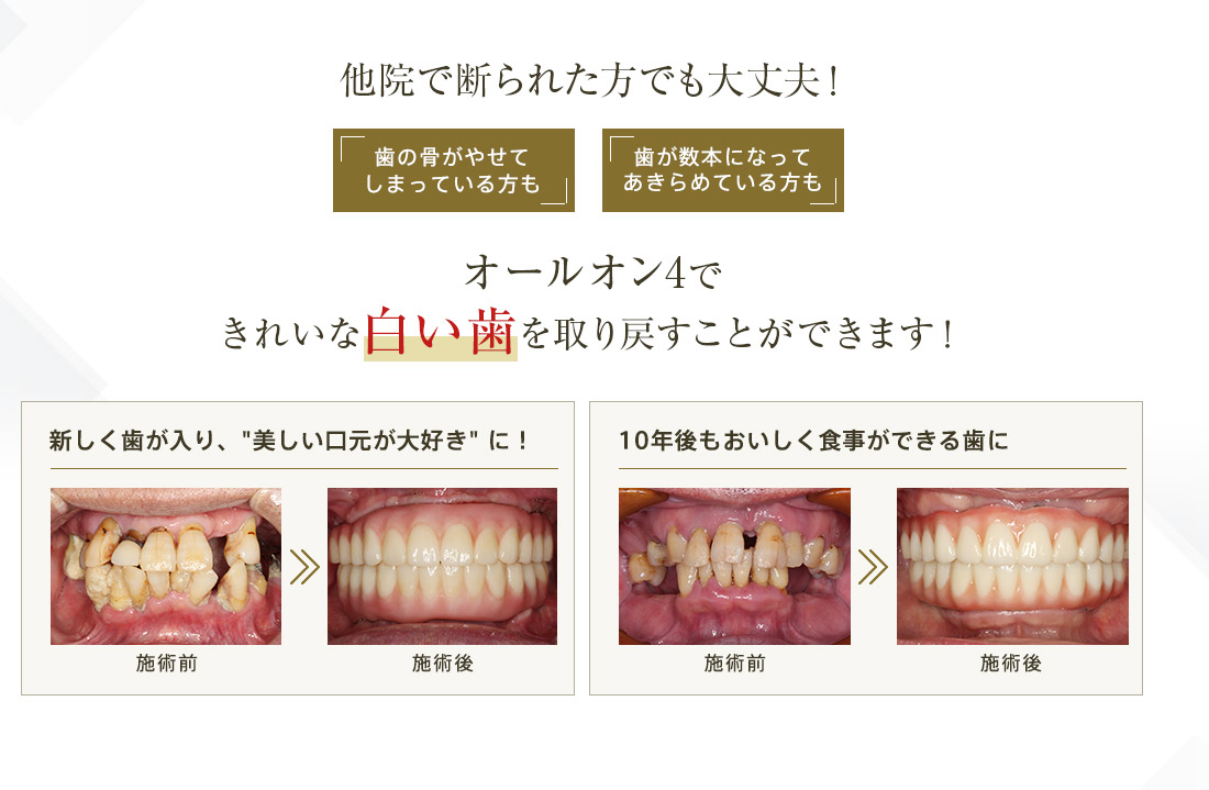 他院で断られた方でも大丈夫!オールオン4できれいな白い歯を取り戻すことができます!