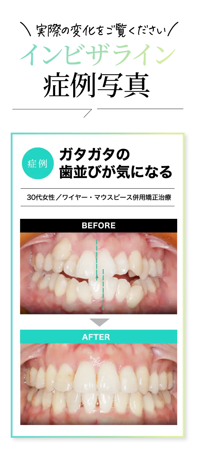 インビザライン症例写真