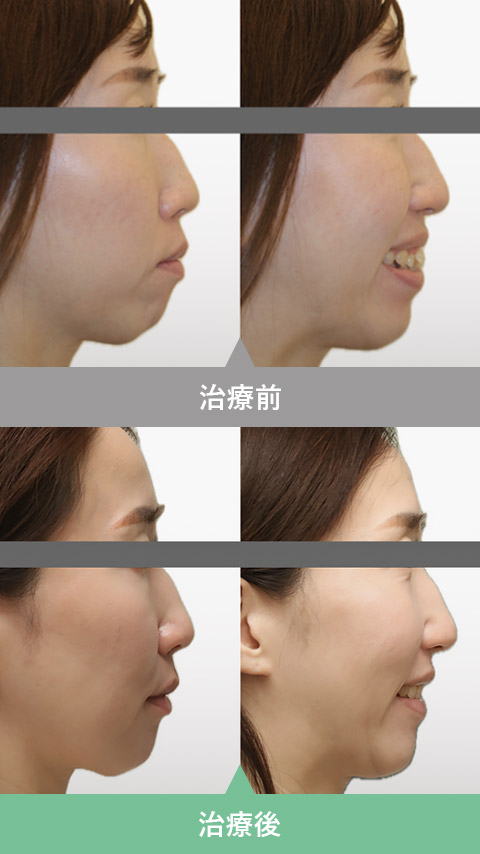 きれいな口ごぼ（Eライン）