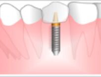 歯が1本ない場合のインプラント費用