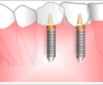 歯が2本ない場合のインプラント費用
