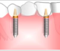 歯が3本ない場合のインプラント費用