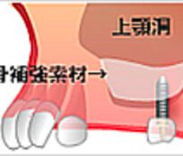 サイナスリフトを用いて1本埋入した場合のインプラント費用