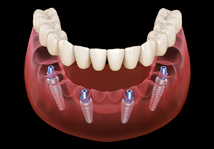 オールオン4について 総入れ歯に不満な方の治療 大阪でインプラントなら大阪つつい歯科 矯正歯科