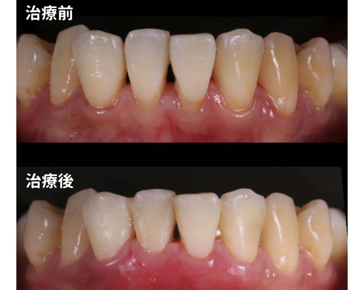 筒井歯科の歯肉退縮の症例VISTAテクニック