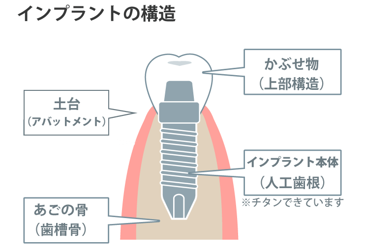 インプラント構造図