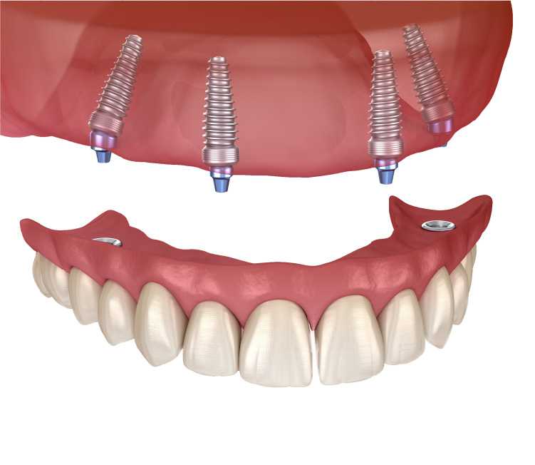 オールオン4について 総入れ歯に不満な方の治療 大阪でインプラントなら大阪つつい歯科 矯正歯科