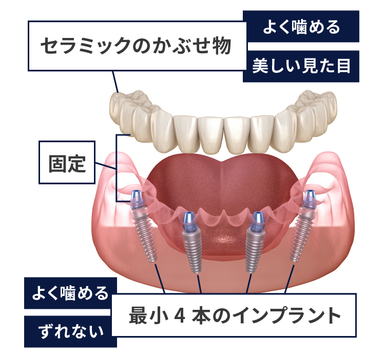 オールオン4仕組み