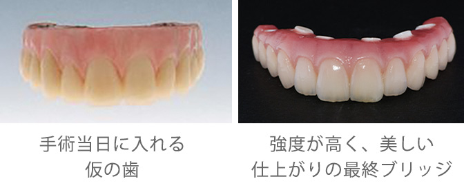 仮の歯と最終のブリッジ 