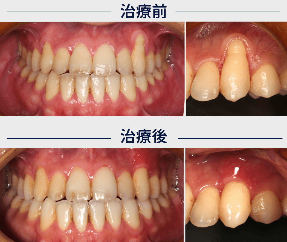 歯肉退縮は治療できます 大阪でインプラントなら大阪つつい歯科 矯正歯科