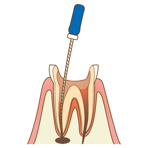 歯の中を清掃する根管治療