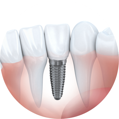 歯がない時のインプラント治療