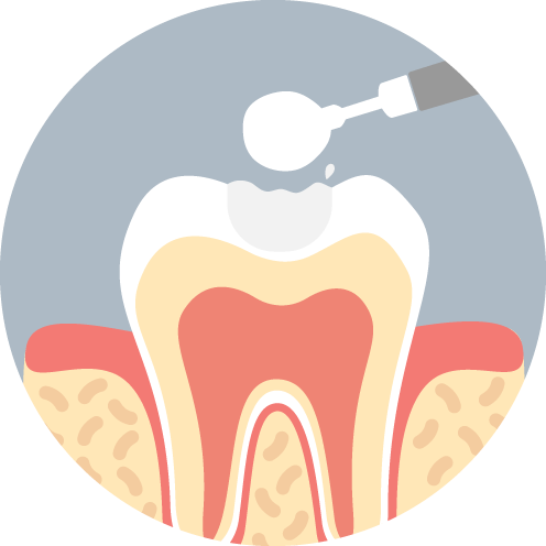 CR（樹脂の詰め物）での虫歯治療
