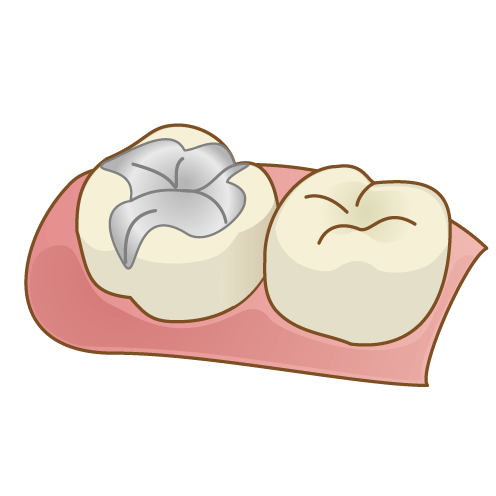 CR（樹脂の詰め物）での虫歯治療