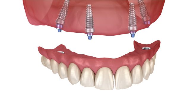 オールオン4（All-on-4）で最小の負担で治療が受けられます