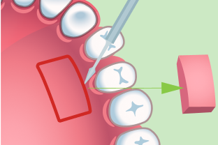 遊離歯肉移植術の手順2