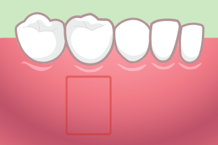 遊離歯肉移植術の手順3