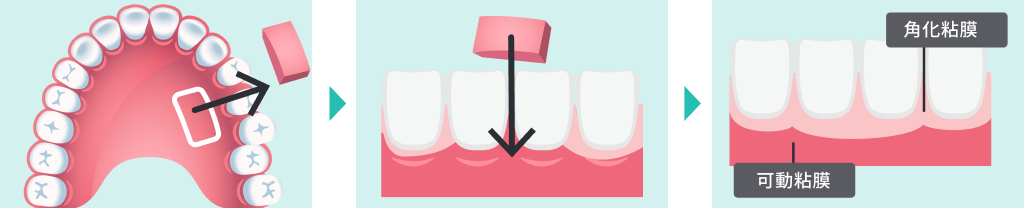 結合組織移植術の手順