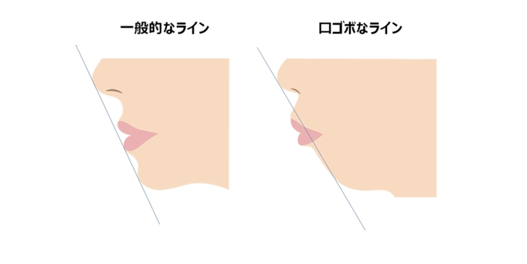 Eライン・口ゴボの比較説明図（一般的なラインとロゴボなライン）